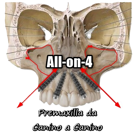 All-on-4: 4 impianti anteriori