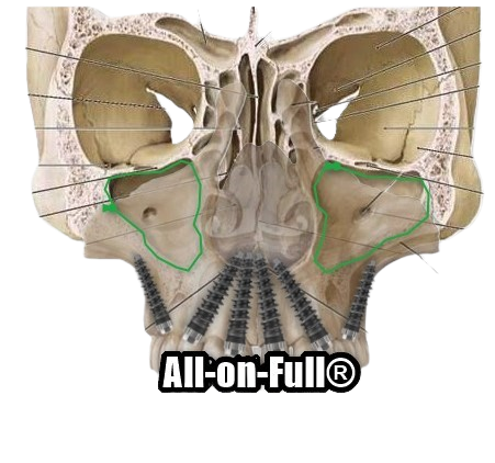 All-on-Full: 14 impianti, ogni dente ha il suo sostegno