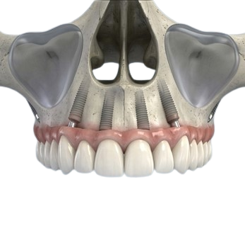 Riabilitazione dell'arcata superiore con impianti dentali per grave atrofia ossea senza ricorso a grandi rialzi del seno: 14 denti in ceramica senza finta gengiva