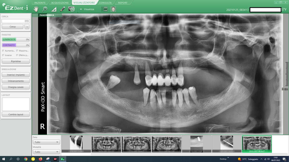 Panoramica post-operatoria Caso 15