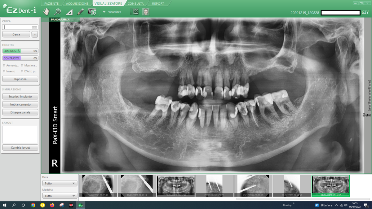 Panoramica post-operatoria Caso 21