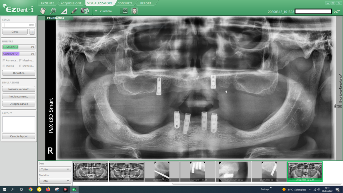 Panoramica pre-operatoria Caso 24