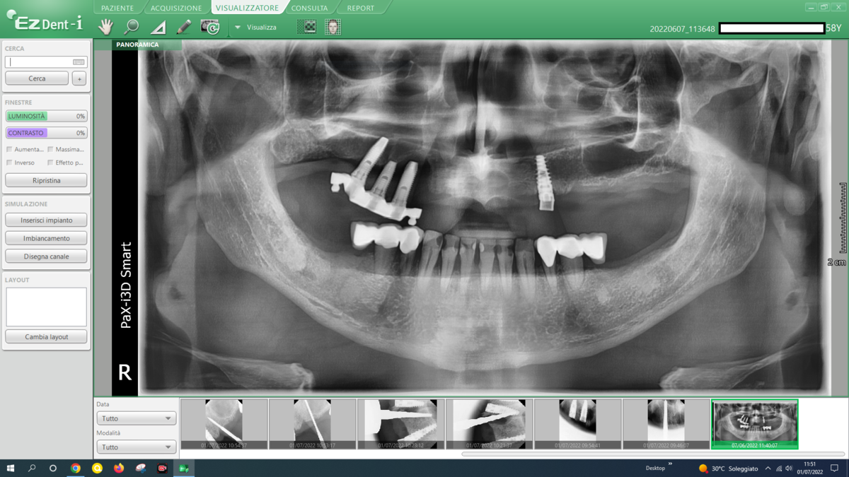 Panoramica post-operatoria Caso 8