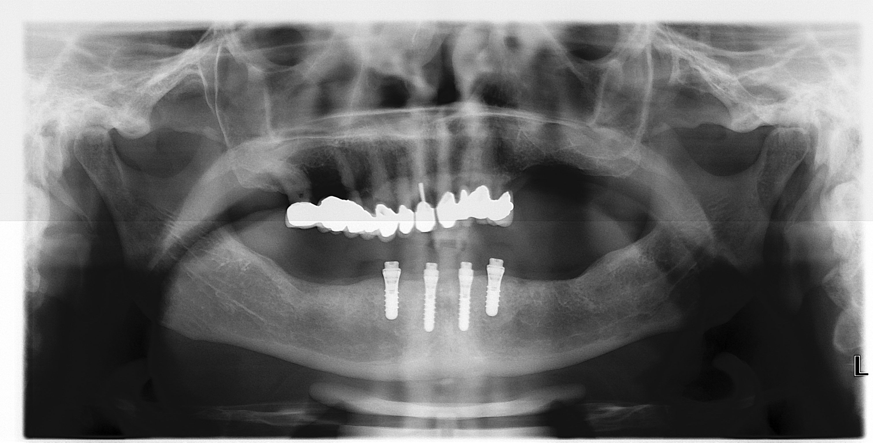 Overdenture su impianti