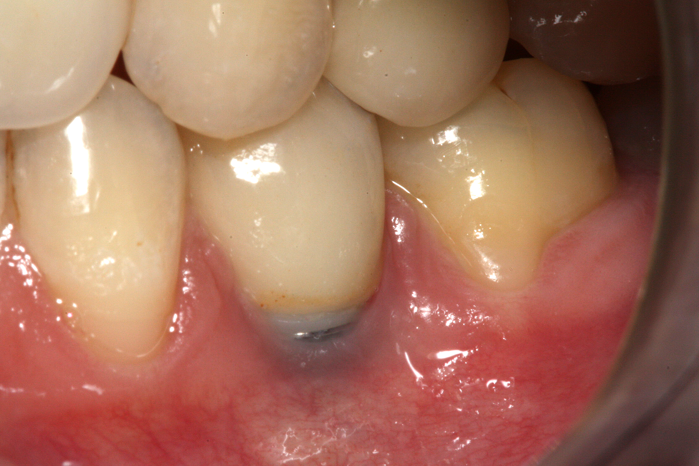 Impianto con perimplantite