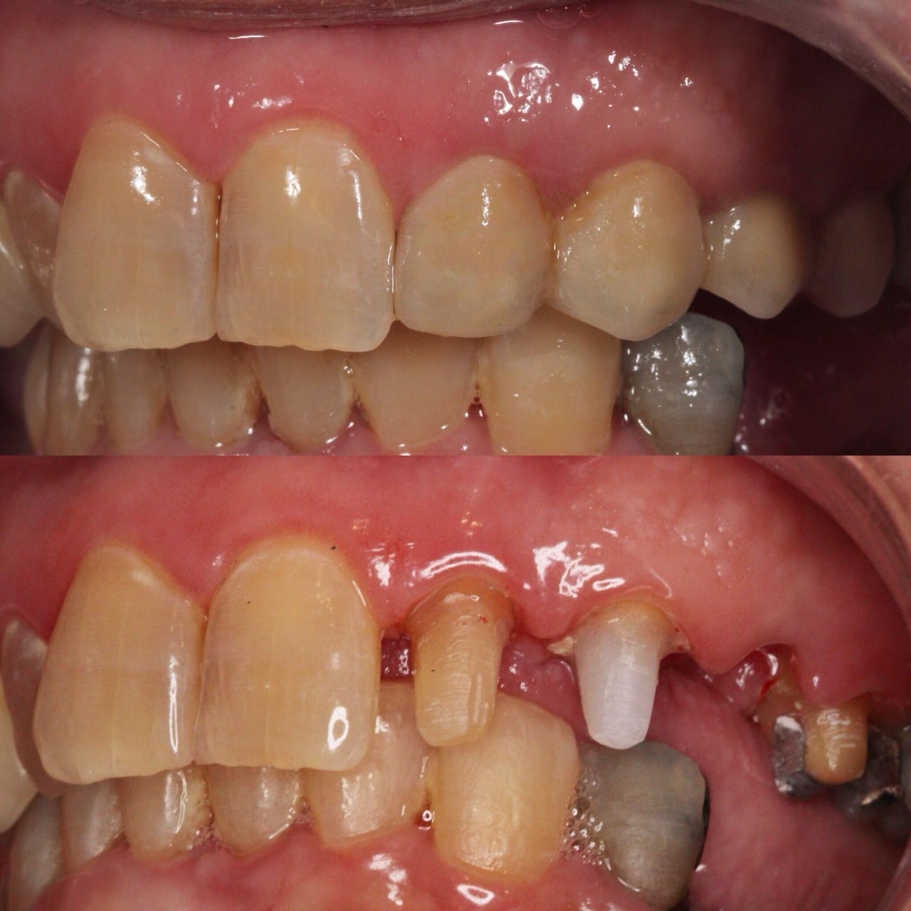 Ponte in zirconia