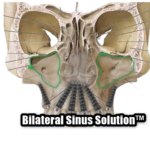 Bilateral Sinus Solution™