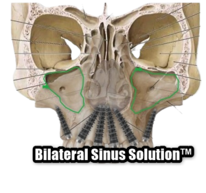 Bilateral Sinus Solution™