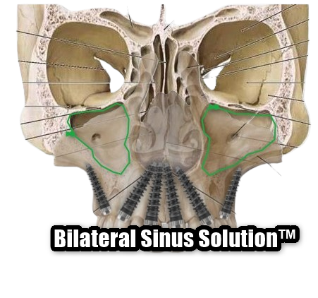 Bilateral Sinus Solution™