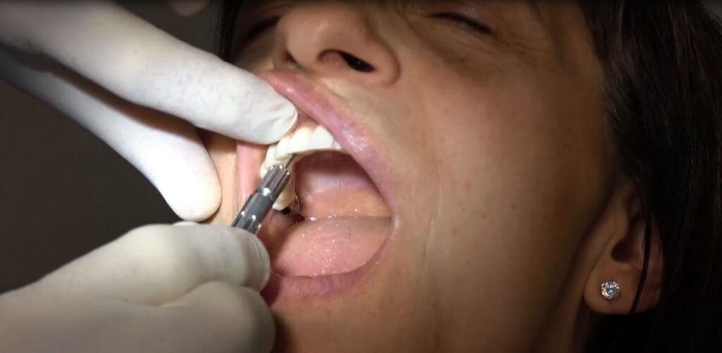 IMPLANTOLOGIA BERGAMO SENZA OSSO TECNICA CHIRURGICA BASALE GRIGLIA SOTTOPERIOSTEA A CARICO IMMEDIATO TUTTI I MOLARI ESTETICI (2)