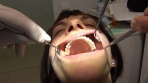 IMPLANTOLOGIA BERGAMO SENZA OSSO TECNICA CHIRURGICA BASALE GRIGLIA SOTTOPERIOSTEA A CARICO IMMEDIATO TUTTI I MOLARI ESTETICI (2)