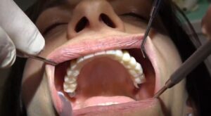 IMPLANTOLOGIA BERGAMO SENZA OSSO TECNICA CHIRURGICA BASALE GRIGLIA SOTTOPERIOSTEA A CARICO IMMEDIATO TUTTI I MOLARI ESTETICI (2)