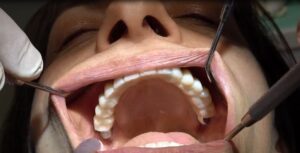 IMPLANTOLOGIA BERGAMO SENZA OSSO TECNICA CHIRURGICA BASALE GRIGLIA SOTTOPERIOSTEA A CARICO IMMEDIATO TUTTI I MOLARI ESTETICI (2)