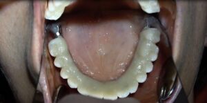IMPLANTOLOGIA BERGAMO SENZA OSSO TECNICA CHIRURGICA BASALE GRIGLIA SOTTOPERIOSTEA A CARICO IMMEDIATO TUTTI I MOLARI ESTETICI (2)