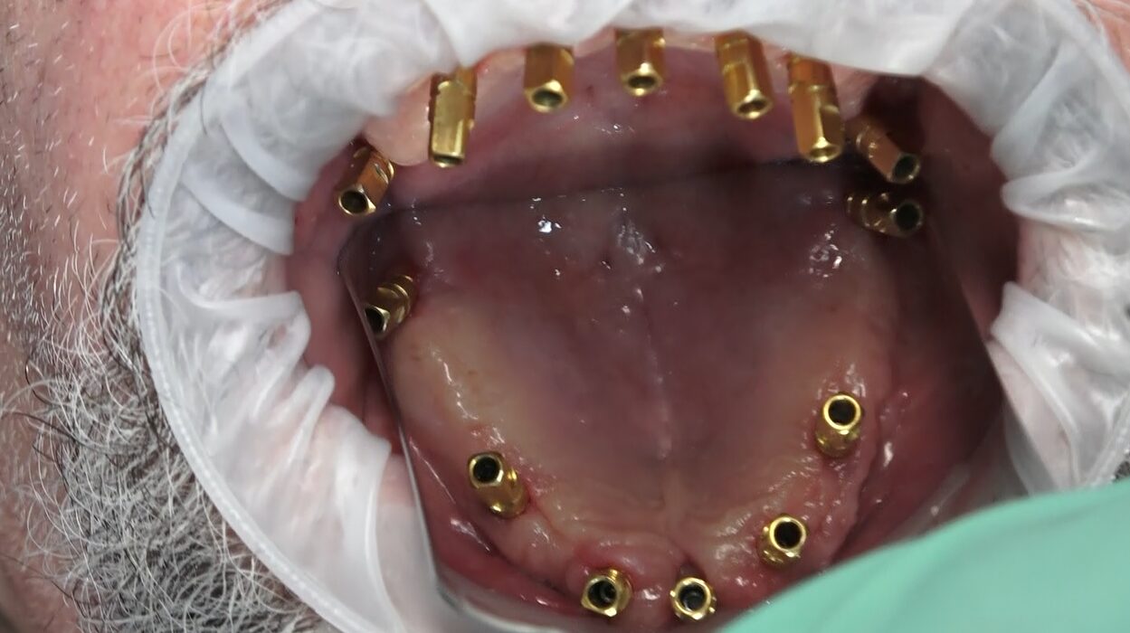 L’Evoluzione Definitiva: quando Bilateral Sinus Solution™ incontra la Protesi Dentale Circolare D’autore®
