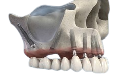 La Bilateral Sinus Solution™ rappresenta una delle risposte chirurgiche più efficaci e mirate per la gestione dell’atrofia mascellare severa