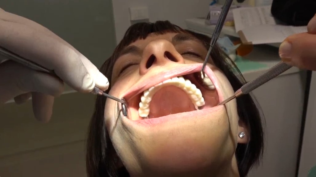 La vera differenza tra All-on-4/6 e All-on-Full: il superamento dell’osso alveolare a favore dell’osso basale D1