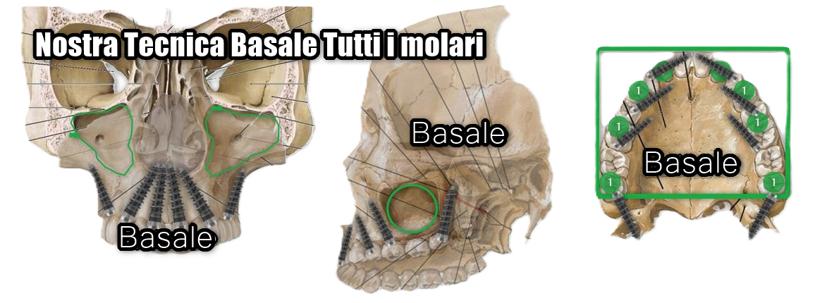 All-on-Full vs. All-on-4/6: La fine dei compromessi clinici e il nuovo standard basale