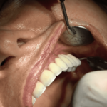 Implantologia senza osso a carico immediato possibile solo con Bilateral sinus solution ALLONFULL BSS