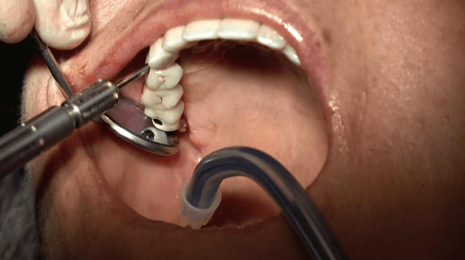 Implantologia senza osso a carico immediato possibile solo con Bilateral sinus solution ALLONFULL BSS