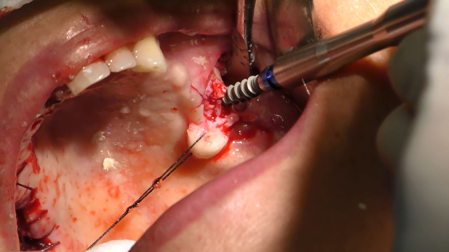 Implantologia senza osso a carico immediato possibile solo con Bilateral sinus solution ALLONFULL BSS