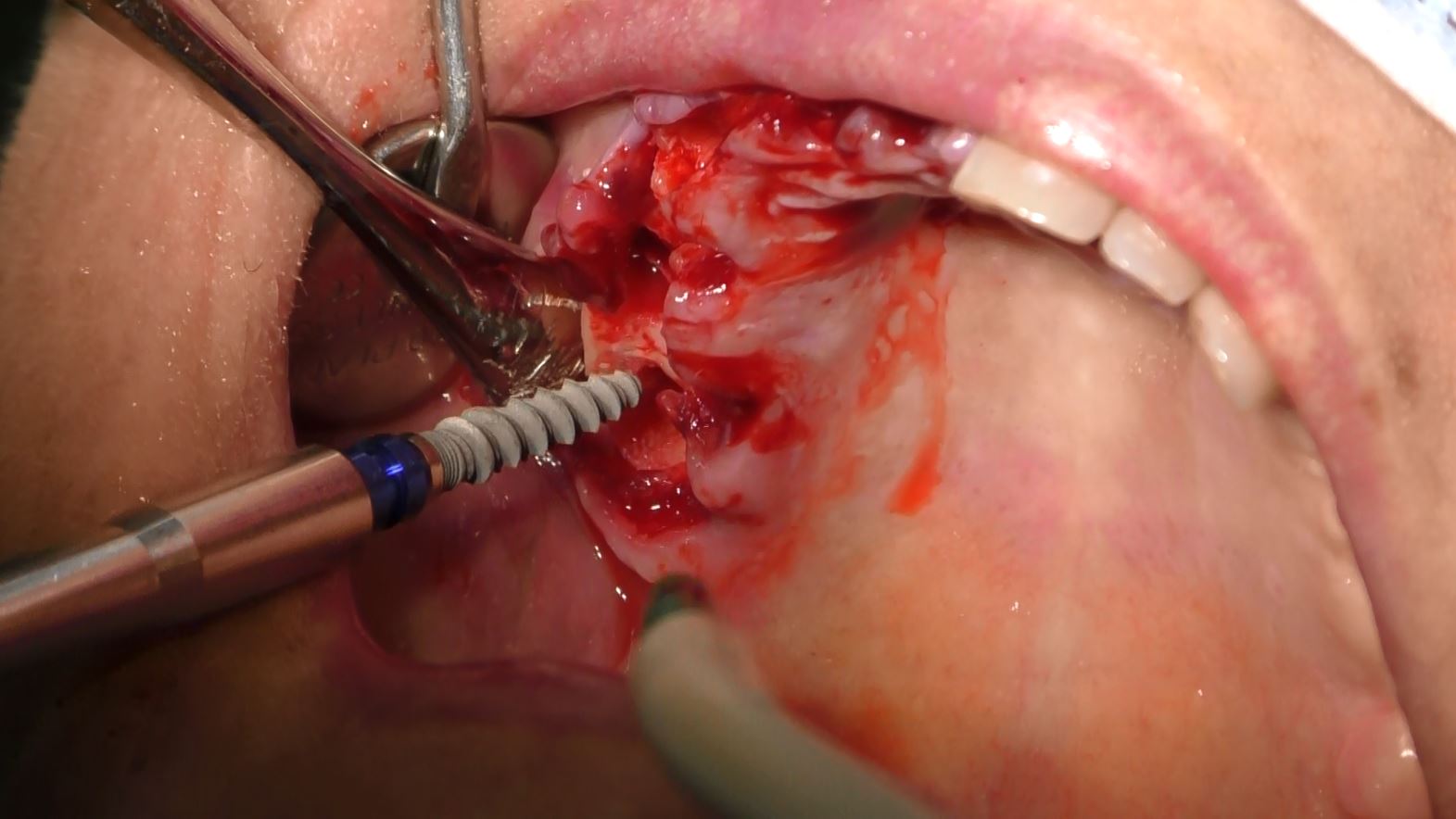Implantologia senza osso a carico immediato possibile solo con Bilateral sinus solution ALLONFULL BSS