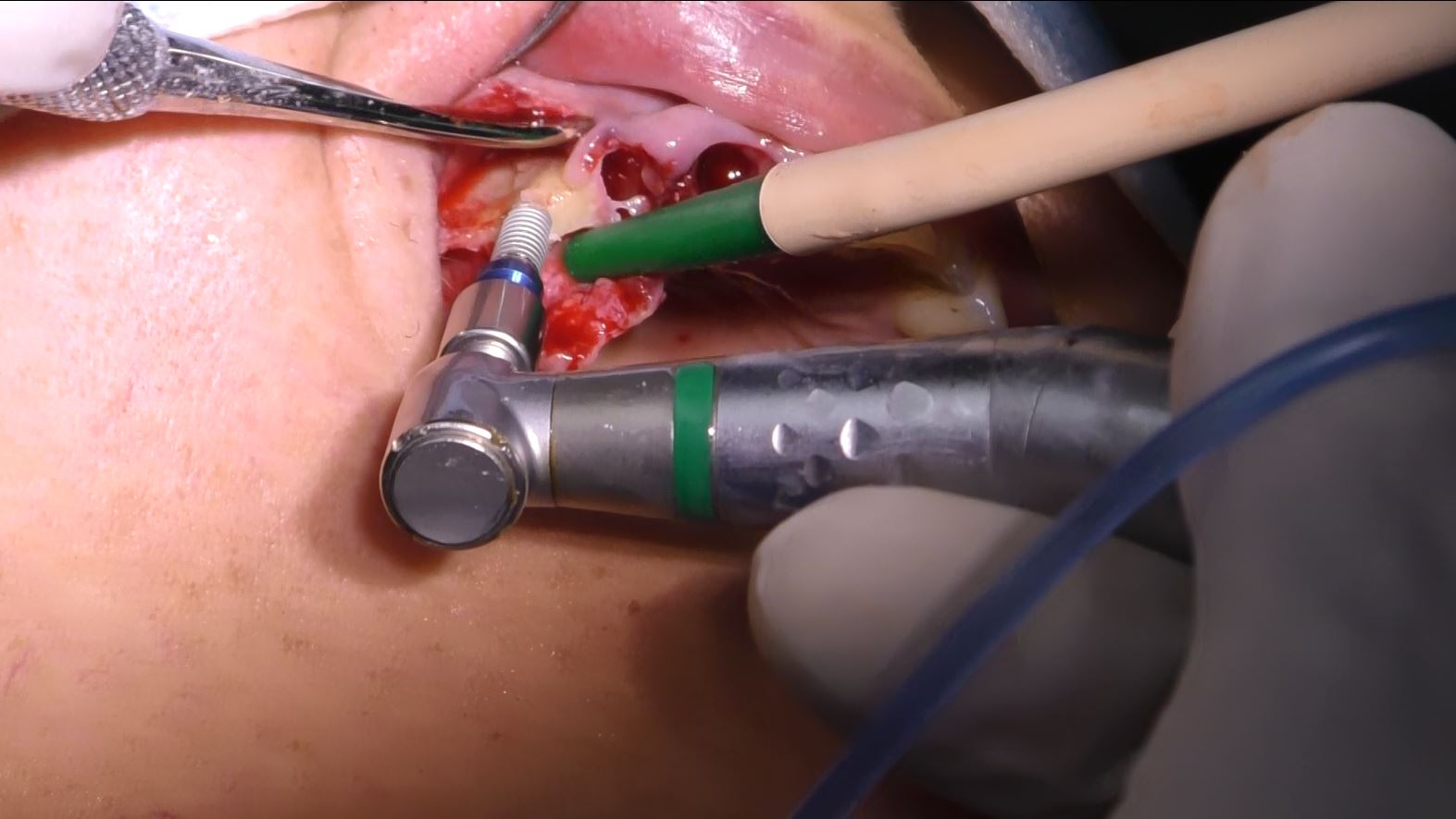 Implantologia senza osso a carico immediato possibile solo con Bilateral sinus solution ALLONFULL BSS