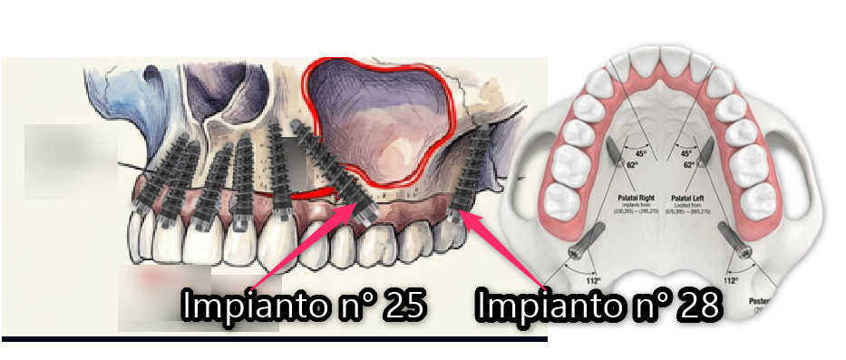 Trovate qui la documentazione visiva del caso: osservate le zone anatomiche 18 28 15 25 e l'efficacia della tecnica All-on-Full BSS.